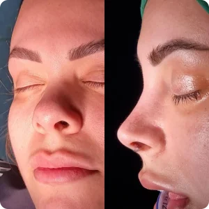 nose job