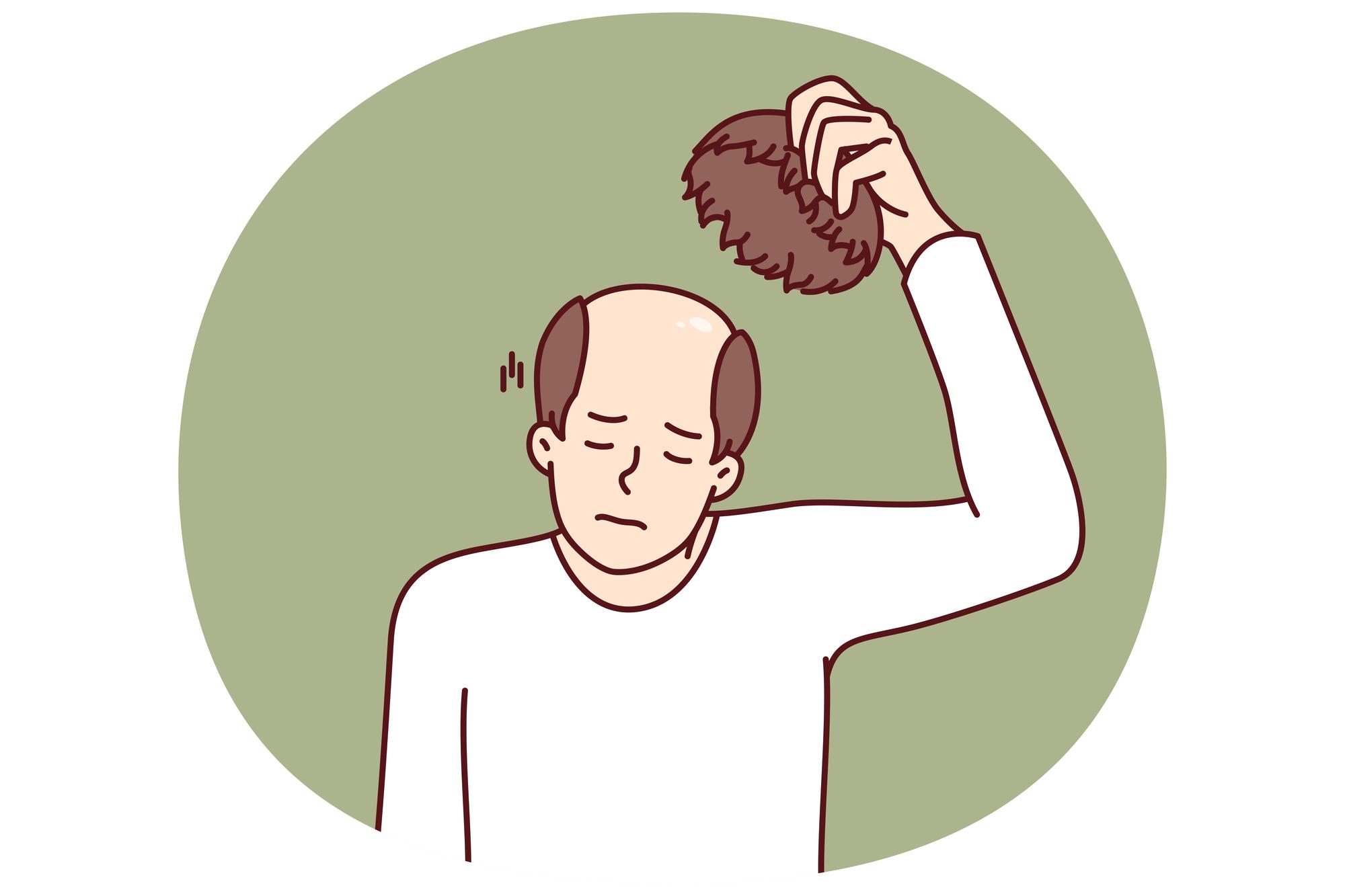 hair transplant iran 3