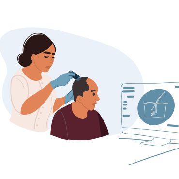 hair transpalnt